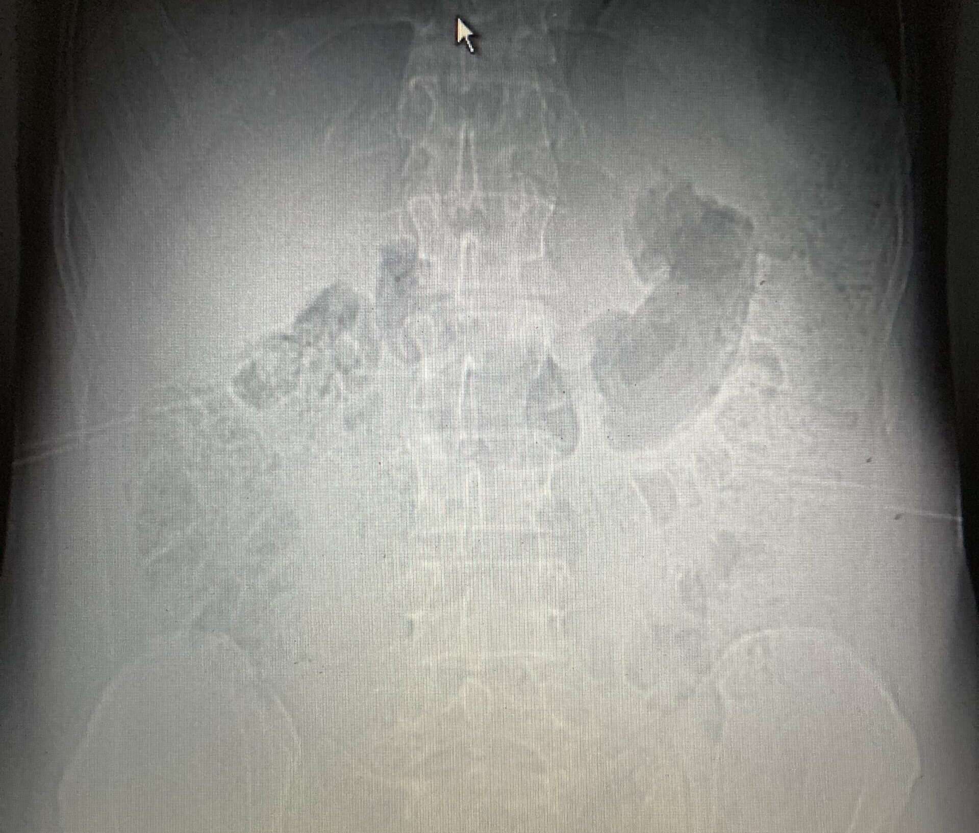 spinal accident injuries not done with bikepacking